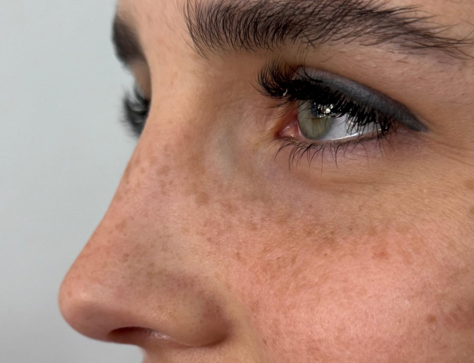 Micropigmentación de Pecas